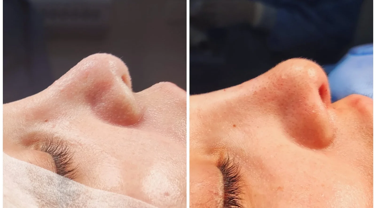 Rinoplastia Antes e Depois 2