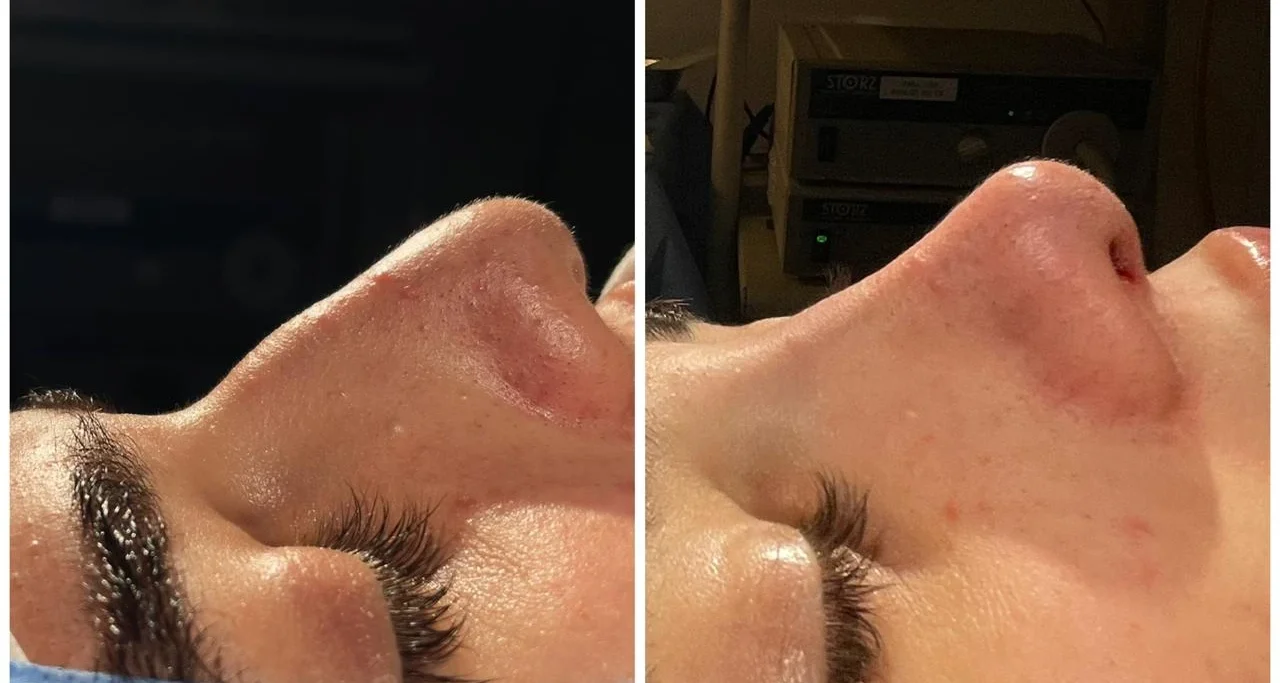 Rinoplastia Antes e Depois 3