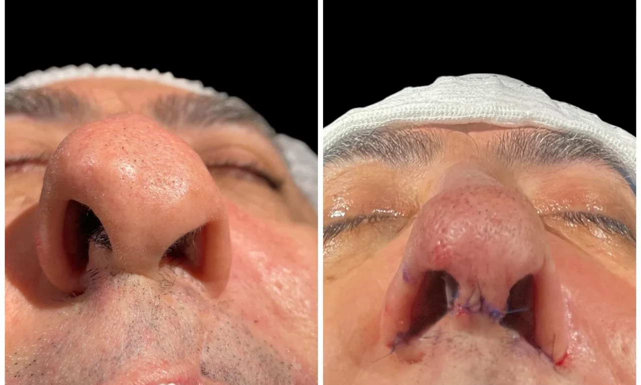 Rinoplastia Antes e Depois 4