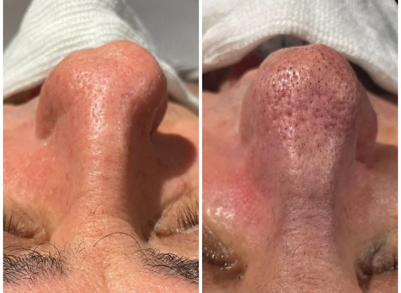 Rinoplastia Antes e Depois 5
